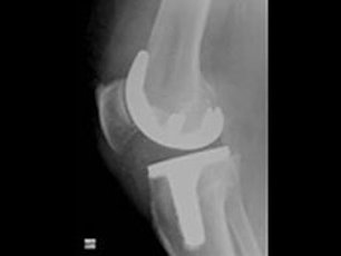 Röntgenbild eines Knies mit Prothese